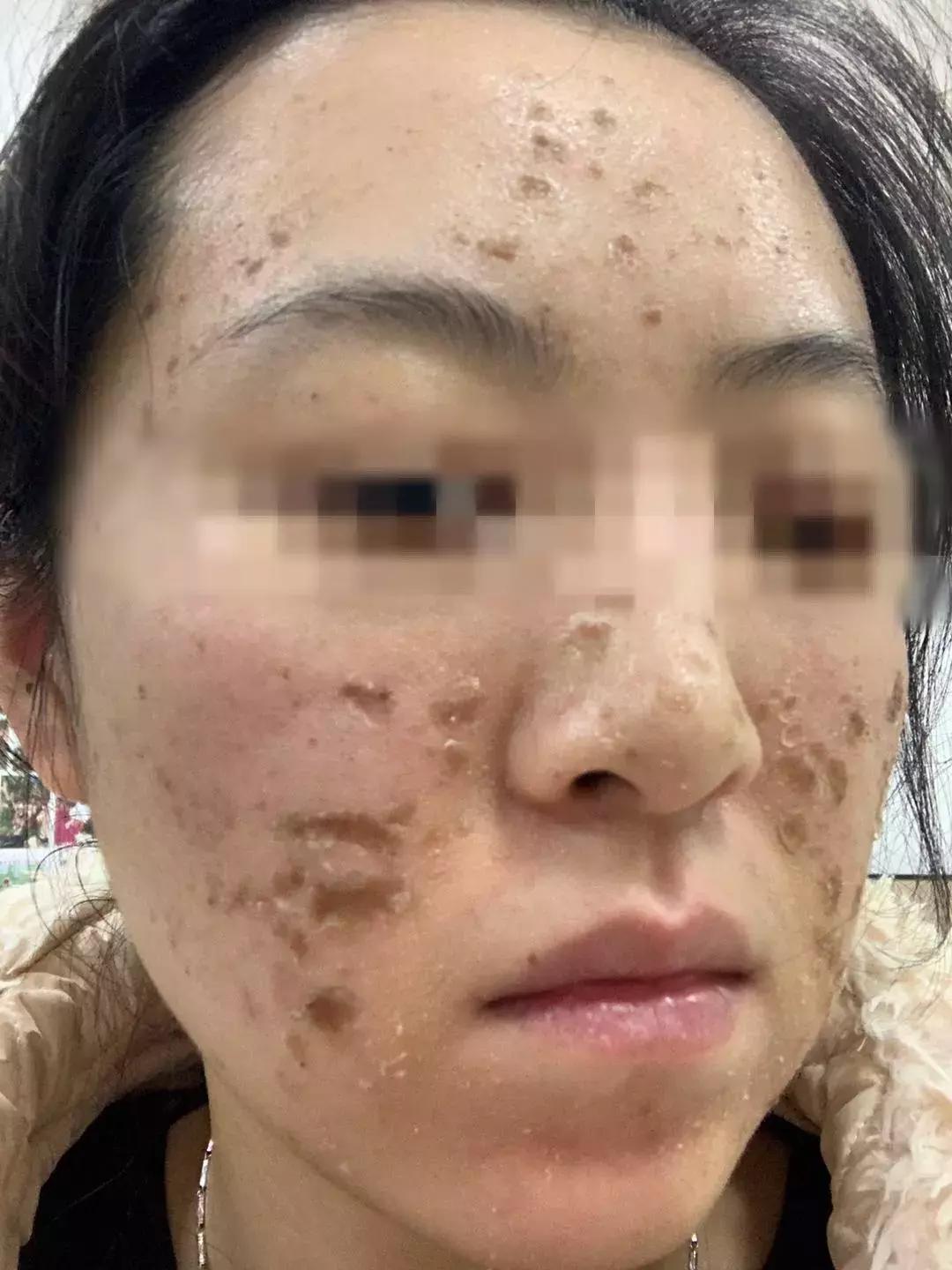 一次美容后她脸烂了！无锡这位女士在整形医院经历了什么……