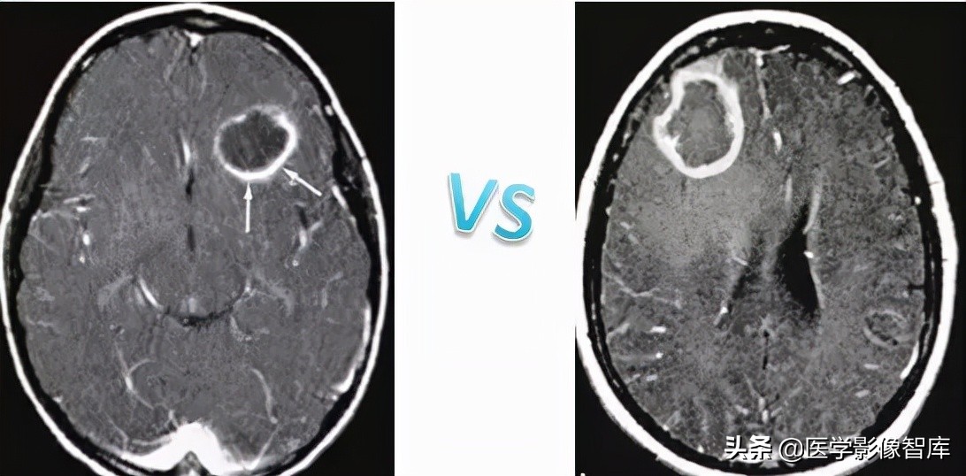 双侧额叶皮层区dwi偏高是什么意思,颅内dwi高信号病变