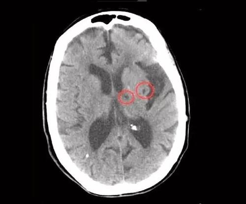 老年人脑梗塞康复锻炼方法,脑梗塞锻炼走路视频大全