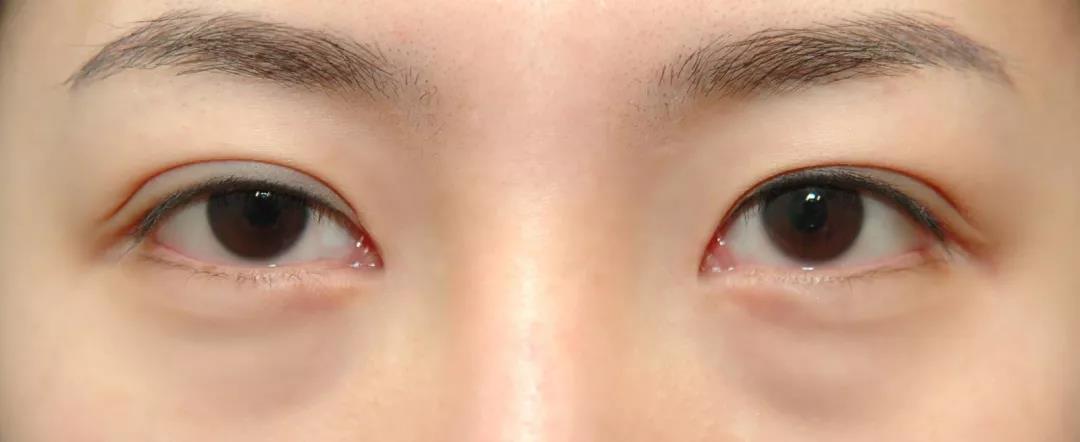 怎样调理身体才能去除眼袋,如何调理可以消除眼袋