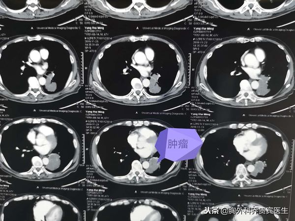 做手术只为了挽救生命,肺癌介入栓塞治疗不能延长生存期