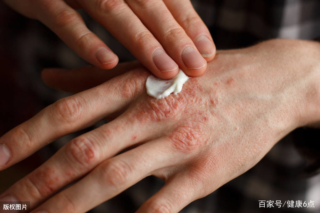 青少年白癜风什么时候可以治疗好,治青少年白癜风最好方法