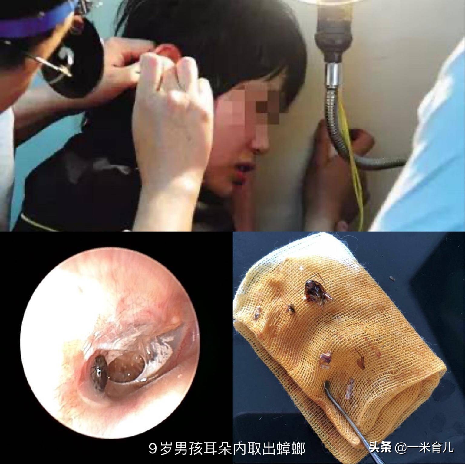 小孩的耳朵怎么护理,宝宝耳朵有异物医生怎么洗