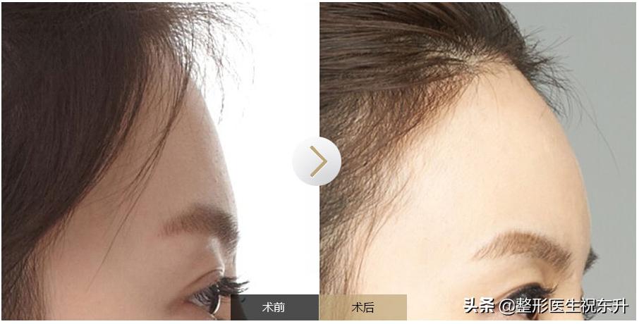 额头打了玻尿酸凹凸不平怎么办,玻尿酸填充额头后凹凸不平