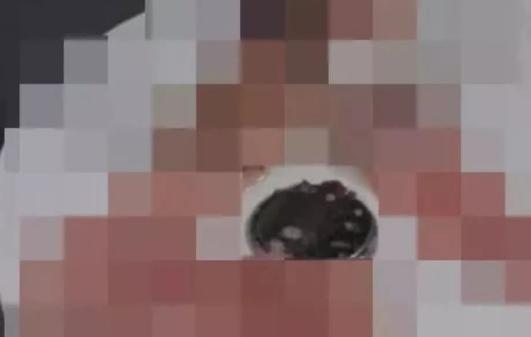 小孩误吞耳环已经到胃里如何处理,儿童误食耳环