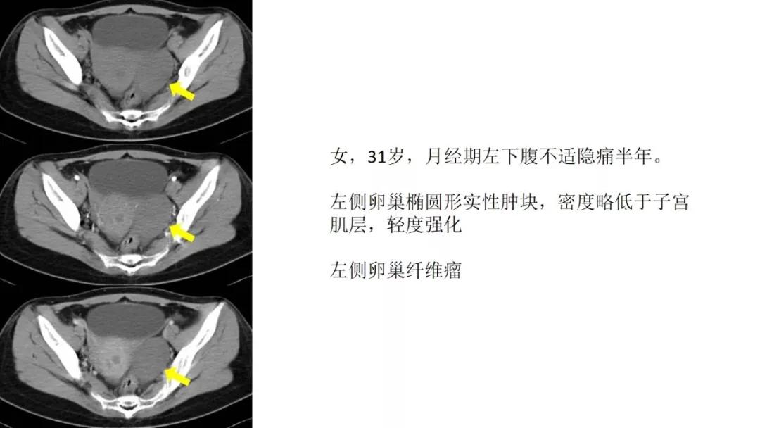 卵巢原发肿瘤的分析思路
