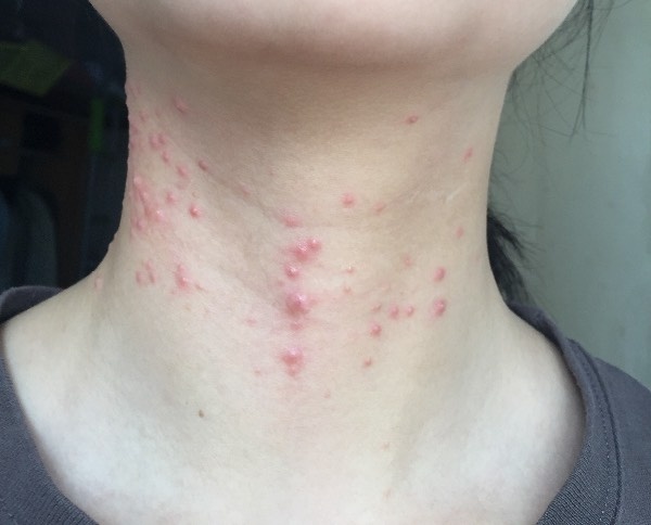脖子上长痘痘的原因及解决方法,脖子上长了很多痘痘什么原因