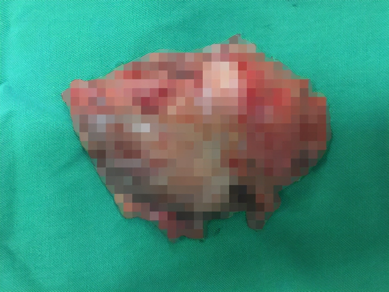 胃肠间质瘤典型病例诊治与解析,桂林医学院附属医院肠胃科