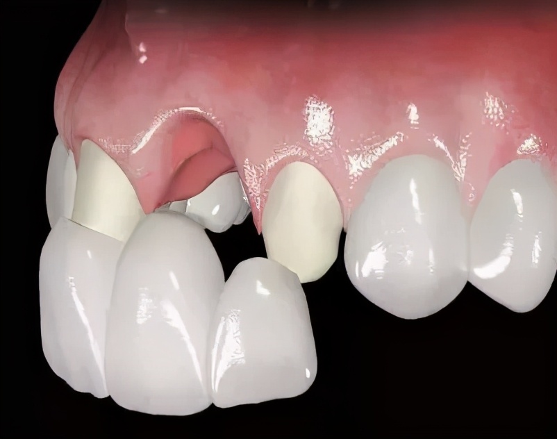 烤瓷牙寿命到了有哪些特征,烤瓷牙的寿命一般是多久