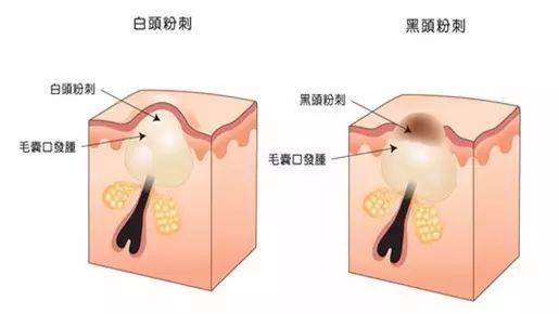 去黑头需用心，一不小心容易毁容，教你辨别祛除黑头的真伪！速进