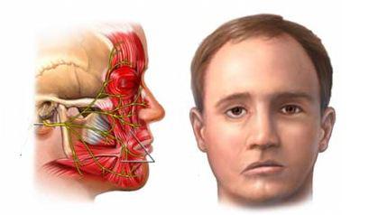 脑中风导致的嘴歪眼斜危害,突然中风嘴歪眼斜多久恢复