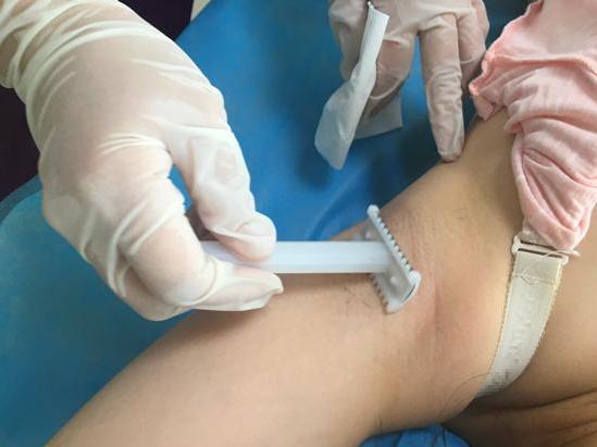 生孩子备皮的尴尬,生娃为啥要备皮