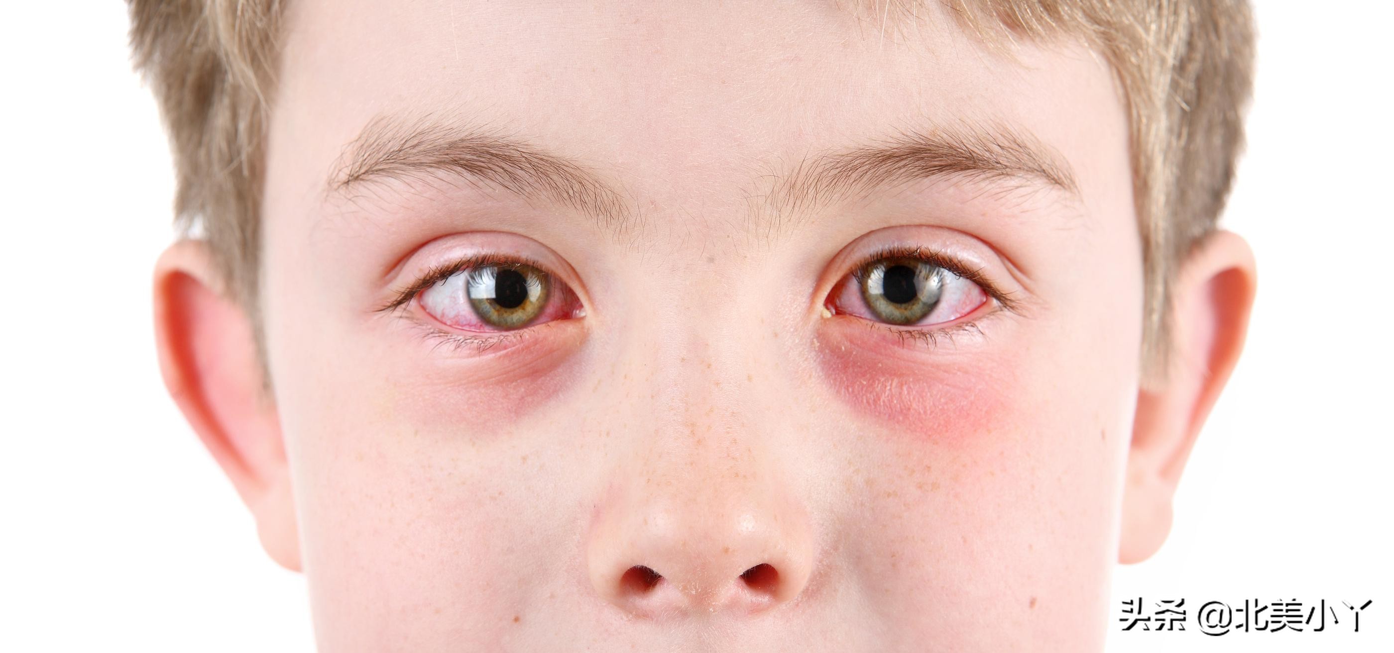 小孩眼部周围红肿有眼屎,儿童眼睛红肿有眼屎结膜炎怎么办