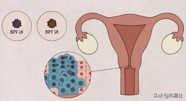 羞羞后警惕HPV感染,一不小心会得宫颈癌