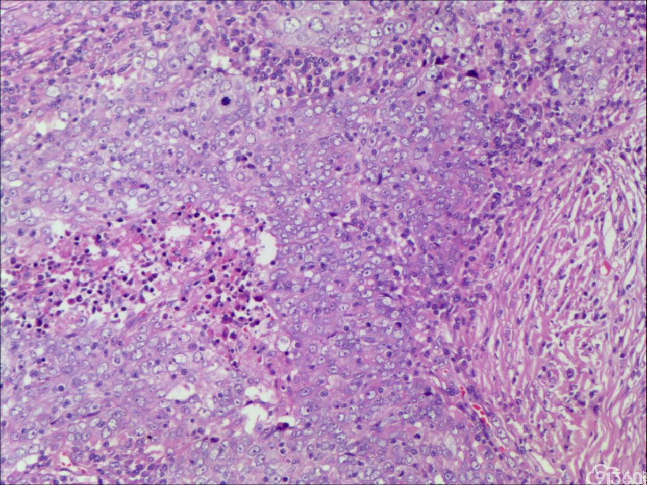 乳腺癌术后如何避免复发？呕血总结：乳腺手术的前世今生