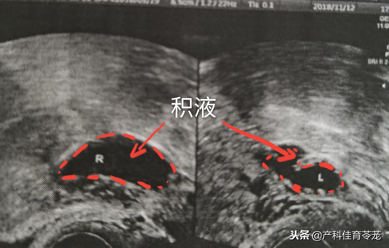 胸腔积液b超显示图,老年妇科b超检查下来有少量积液