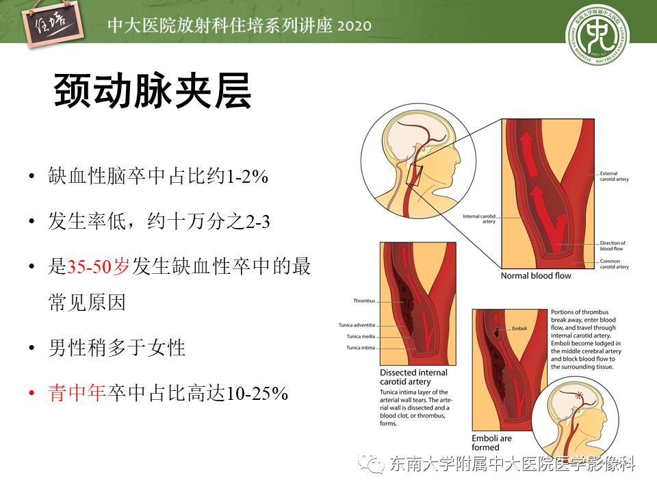 颈动脉夹层的超声表现及漏诊分析,动脉夹层与夹层动脉瘤是一样的吗
