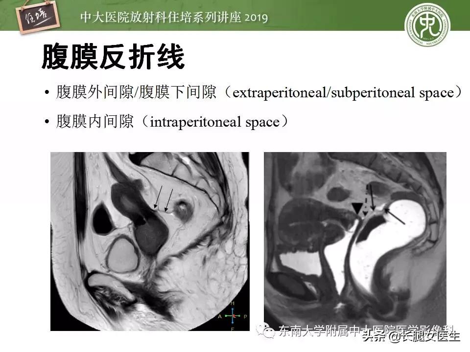 女性生殖子宫影像解剖及生理改变