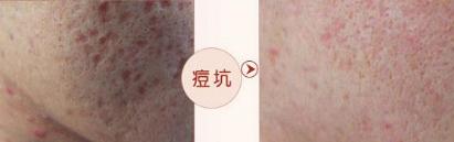 最有效祛痘疤方法,祛痘疤最有效的方法学生