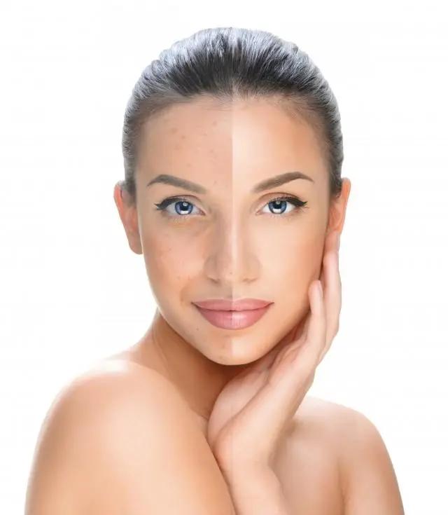 下巴长黑疙瘩怎么去除,下巴长个痦子怎么安全除去