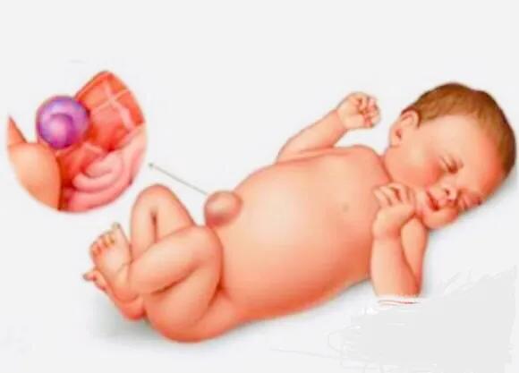 肚脐凸出来,十有八九是脐疝,大多会自愈