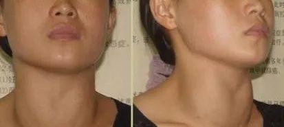 全国甲状腺知识宣传周,国际甲状腺知识宣传周央视