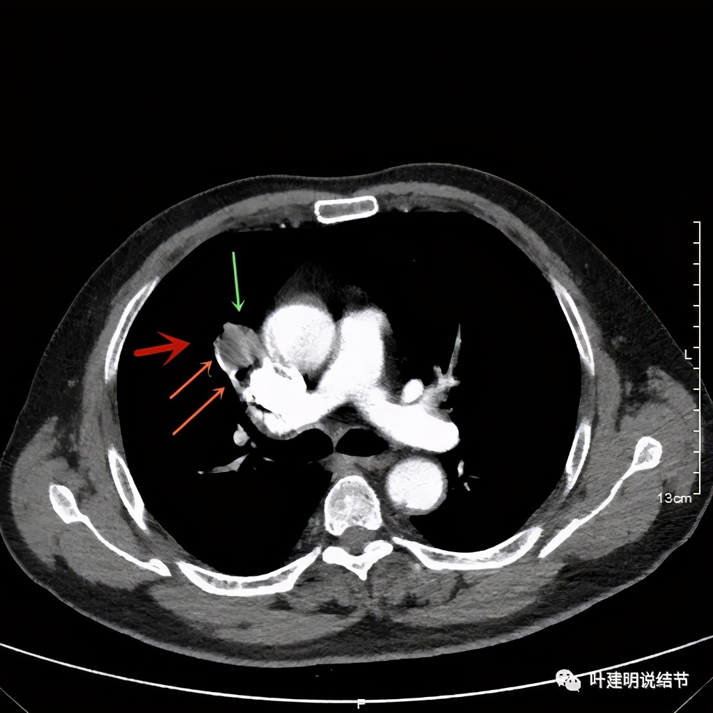 误诊报告图片,误诊案例及案例分析