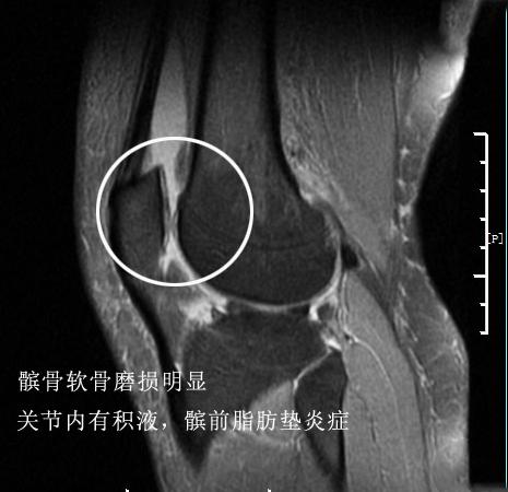 面对多种治疗半月板损伤的办法，我们应该做加法还是做减法？