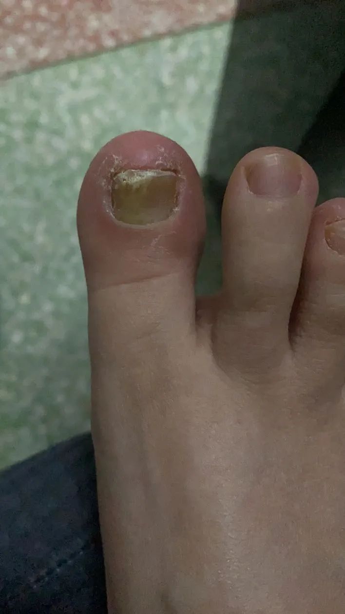 及时治疗脚气，是对家人最好的负责