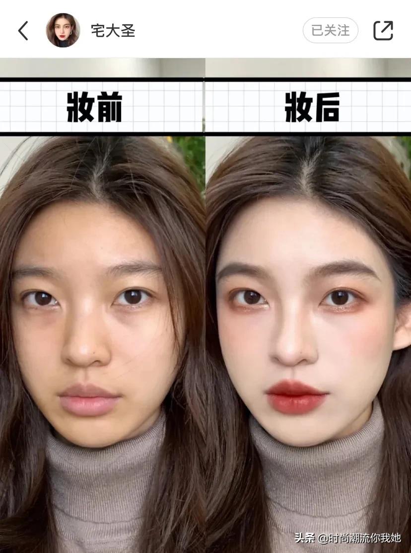 单眼皮凸嘴素人改造,肿眼泡整容成功案例