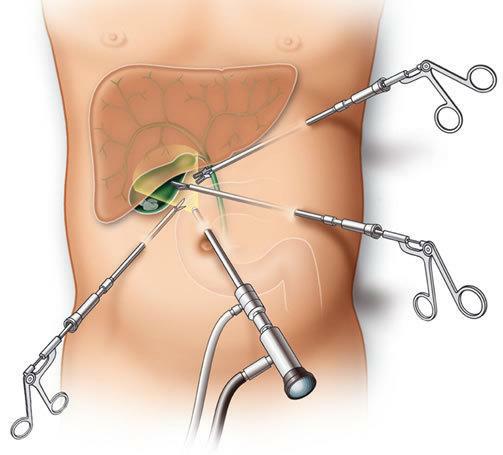 胆囊切除术后注意事项和饮食禁忌,微创胆囊切除手术出院后注意事项