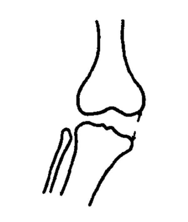 膝关节x线片可以查出啥,膝关节间隙x线测量方法