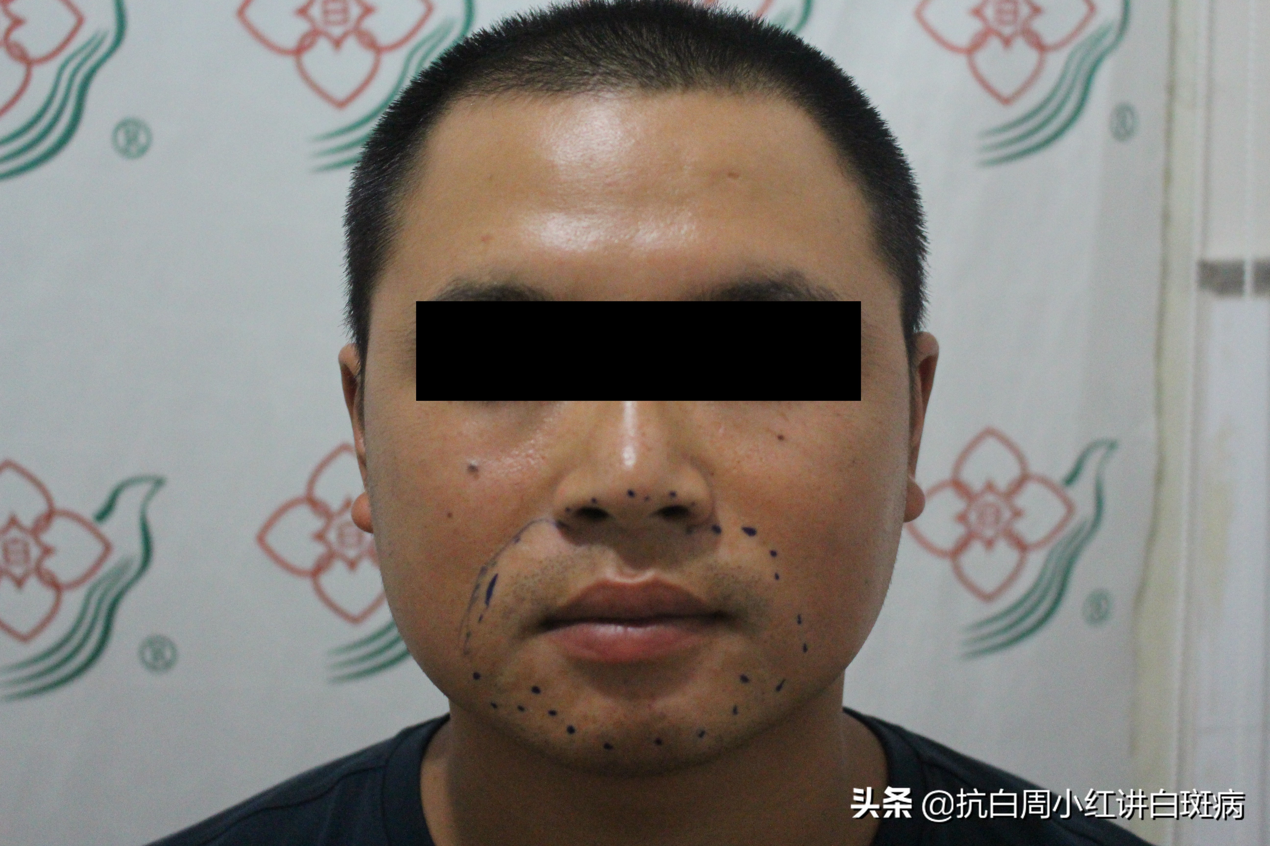 用实际康复案例详解白癜风的中医治疗，附治疗视频