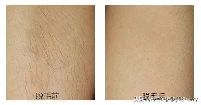 9招帮你轻松脱毛,避开3大脱毛雷区