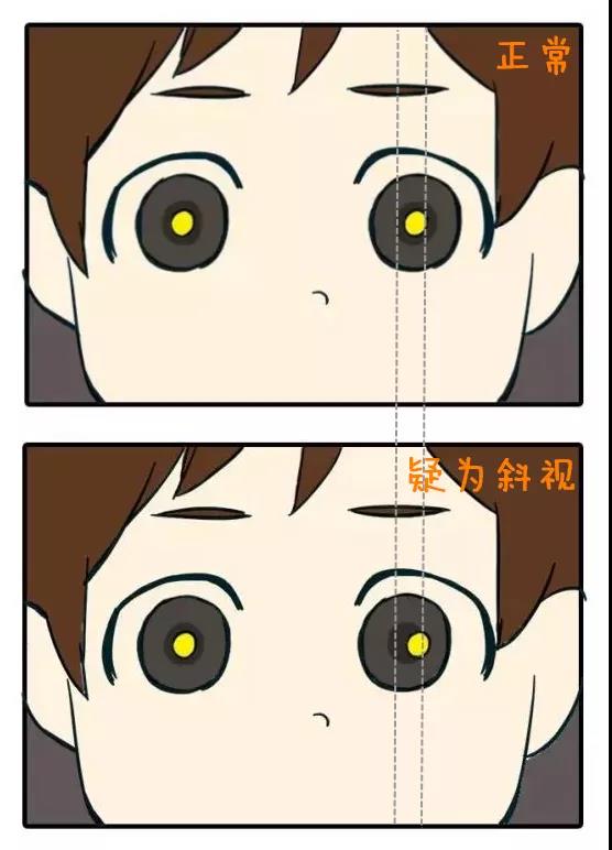 歪头看是斜视吗,偏头看手机会斜视么
