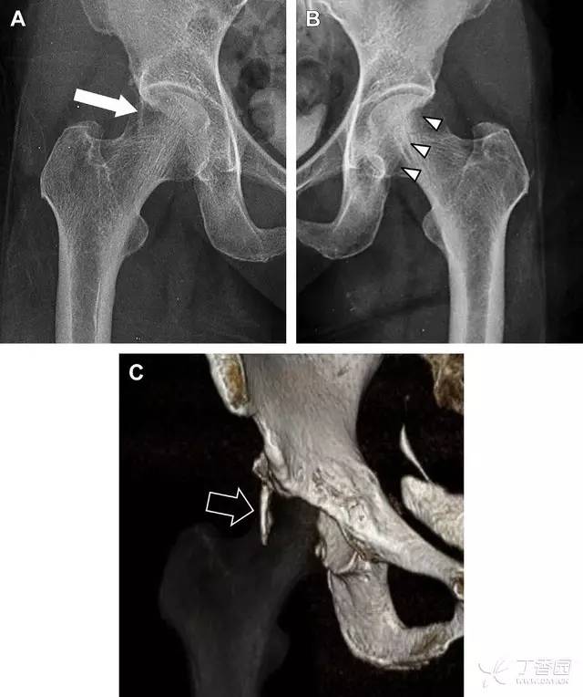 常见的八种骨折,容易漏诊的肩关节骨折