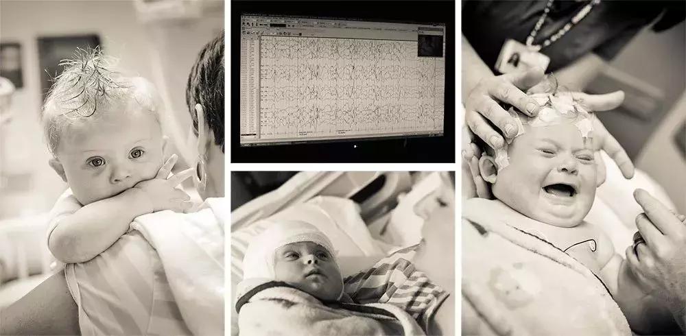 癫痫患儿救命药,婴儿癫痫痉挛性发作的激素疗法