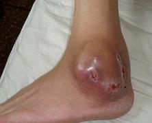 拒绝骨髓手术,中医治疗骨结核