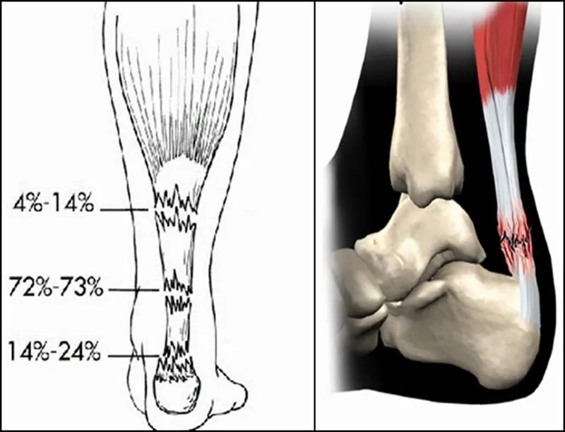 跟腱断裂术后康复训练,跟腱断裂恢复的小偏方