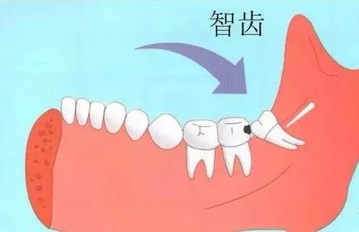 智齿拔除后怎么处理智齿,智齿有必要拔吗智齿痛怎么办