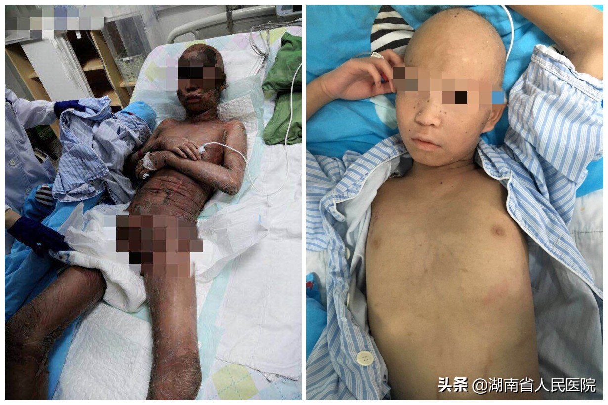 罕见病男孩湖南,罕见病湖南男孩