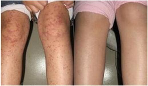 过敏性紫癜呕吐肚子痛怎么治,过敏性紫癜一拉大便就肚子痛