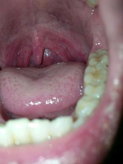 慢性咽炎有异物感吃什么药效果好,慢性咽喉炎吃咽炎片能完全治愈吗