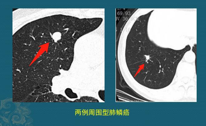新冠肺部感染应对,新冠肺癌抗癌