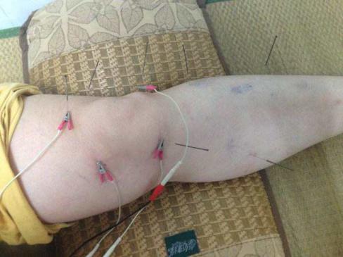 骨关节炎康复治疗方案,骨关节炎康复科普知识宣传