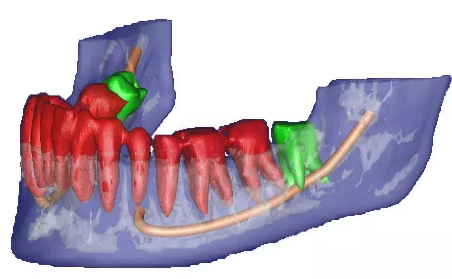 那些不拔智齿的人后来都怎么样了,那些该拔不拔的智齿最后都咋样了