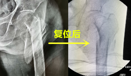老人摔一跤屁股骨折,老人一屁股坐在地上大腿骨折