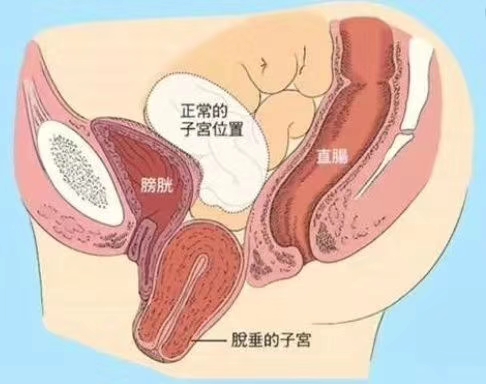 分娩时内壁损伤原因,女性分娩后带来的后遗症