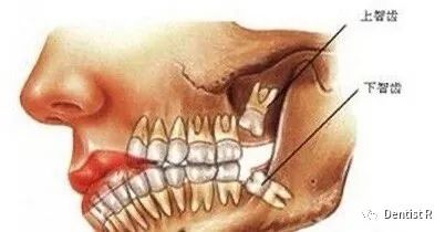 拔智齿能治脸歪吗,科普拔了智齿真的可以瘦脸吗