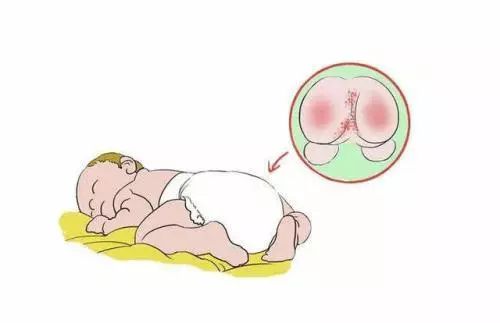 冬季宝宝常见的皮肤病,宝宝常见夏季皮肤问题